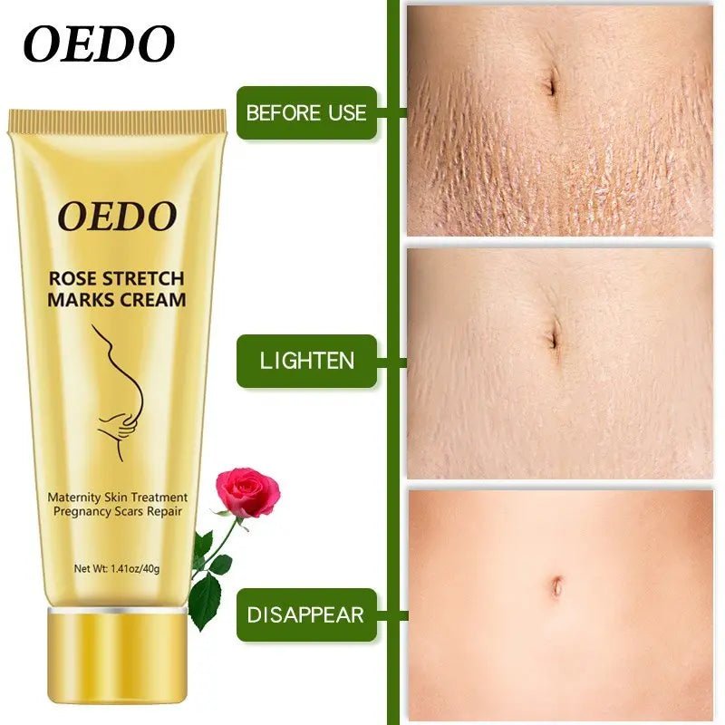 Best Stretch Mark Cream: Skin Elasticity Treatment - Fernglow